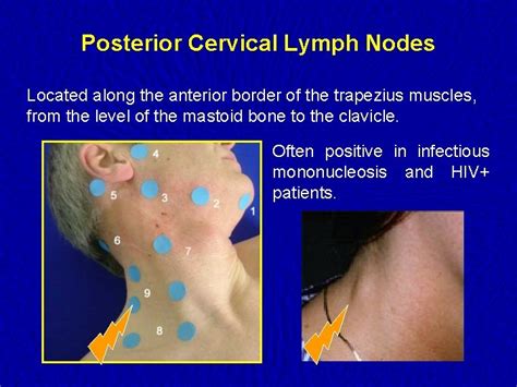 How long can a. . Reactive lymph nodes for years